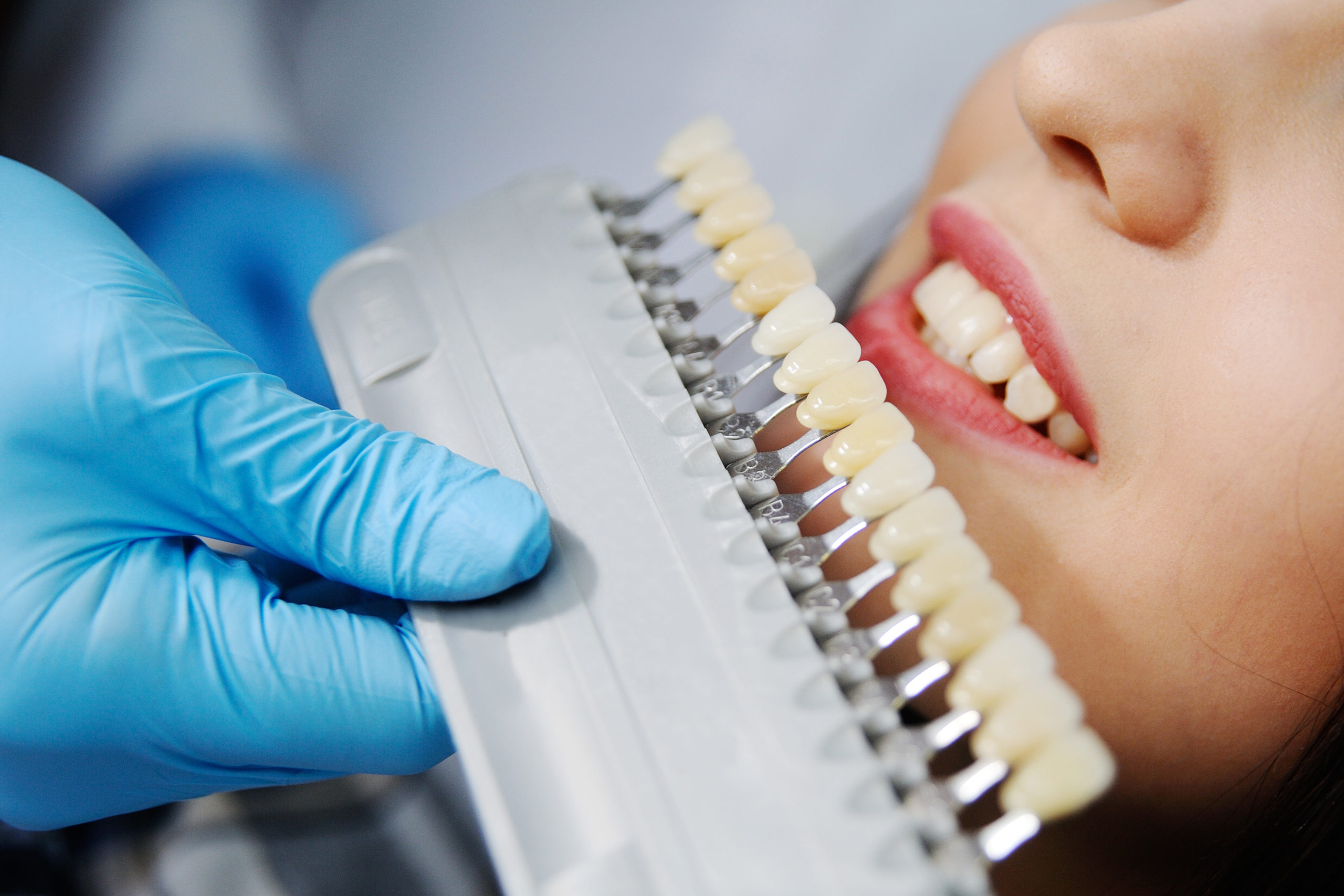 Отбеливание зубов минусы. Отбеливание зубов. Стоматологическое отбеливание. Отбеливание зубов в стоматологии. Профессиональное отбеливание зубов.