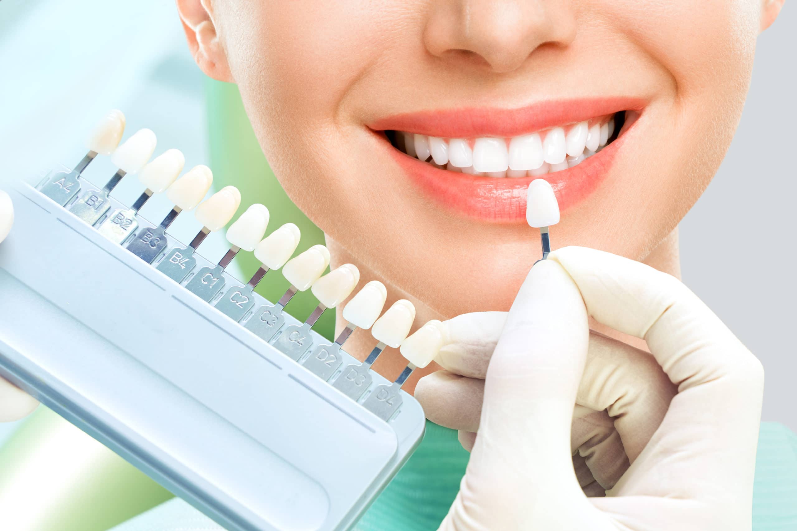 Для отбеливания зубов используют. Отбеливание зубов. Кабинетное отбеливание зубов. Эстетическая стоматология.