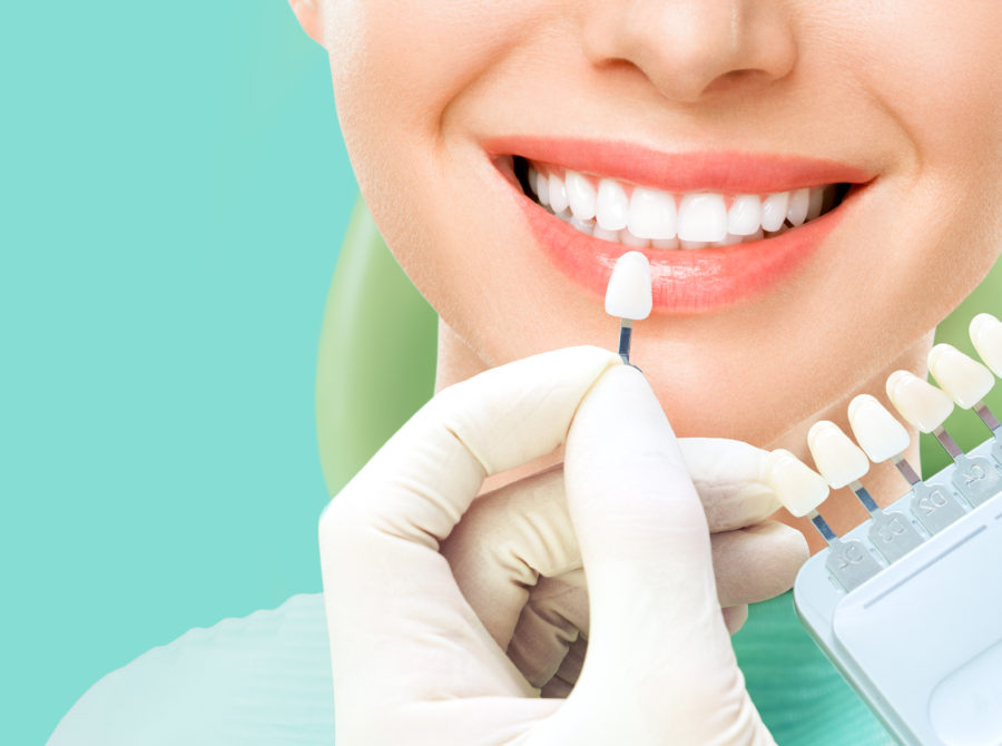 teeth whitening ballantyne